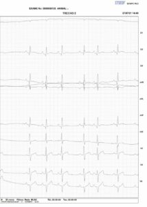 eletrocardiograma 2